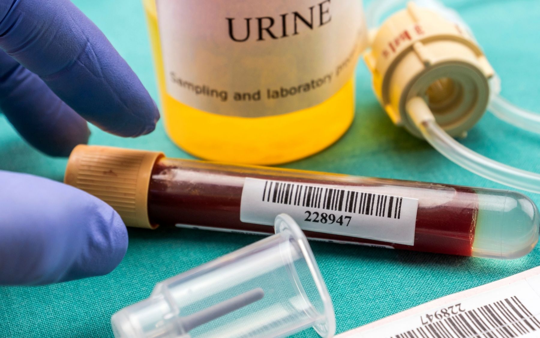 What Causes Temporary Blood In Urine